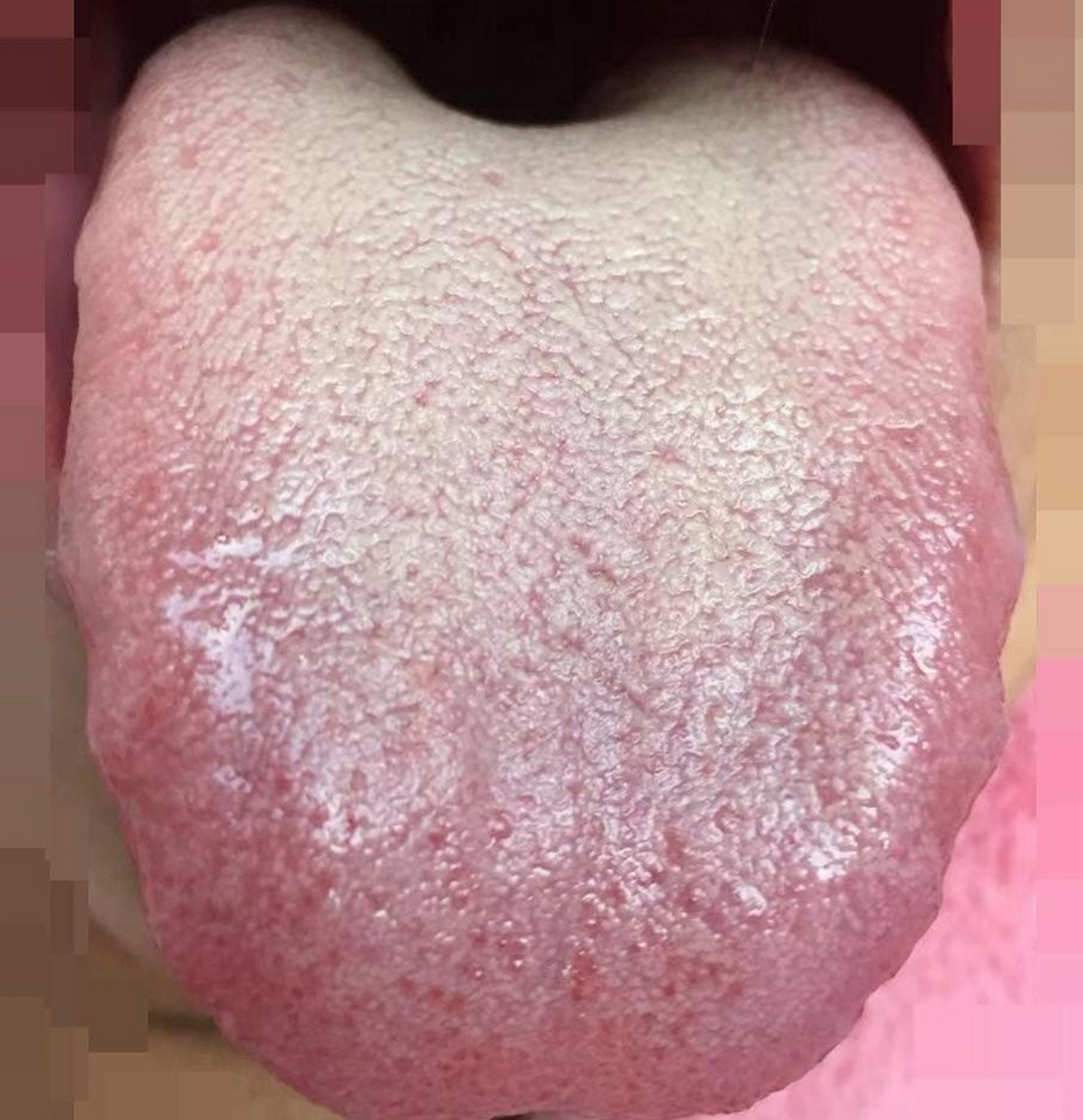 舌苔又厚又腻,舌边有齿痕,舌尖还有红点,舌根舌苔也厚到底是什么原因