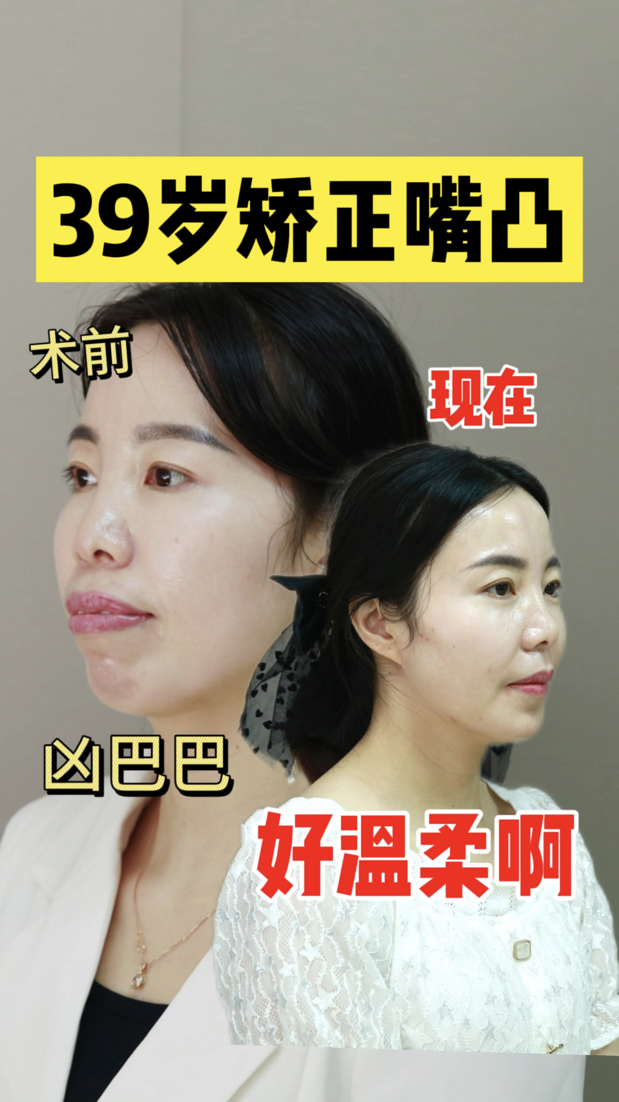 整牙前后惊人对比,39岁龅牙女士正颌,从显凶阿姨变知性姐姐!-度小视
