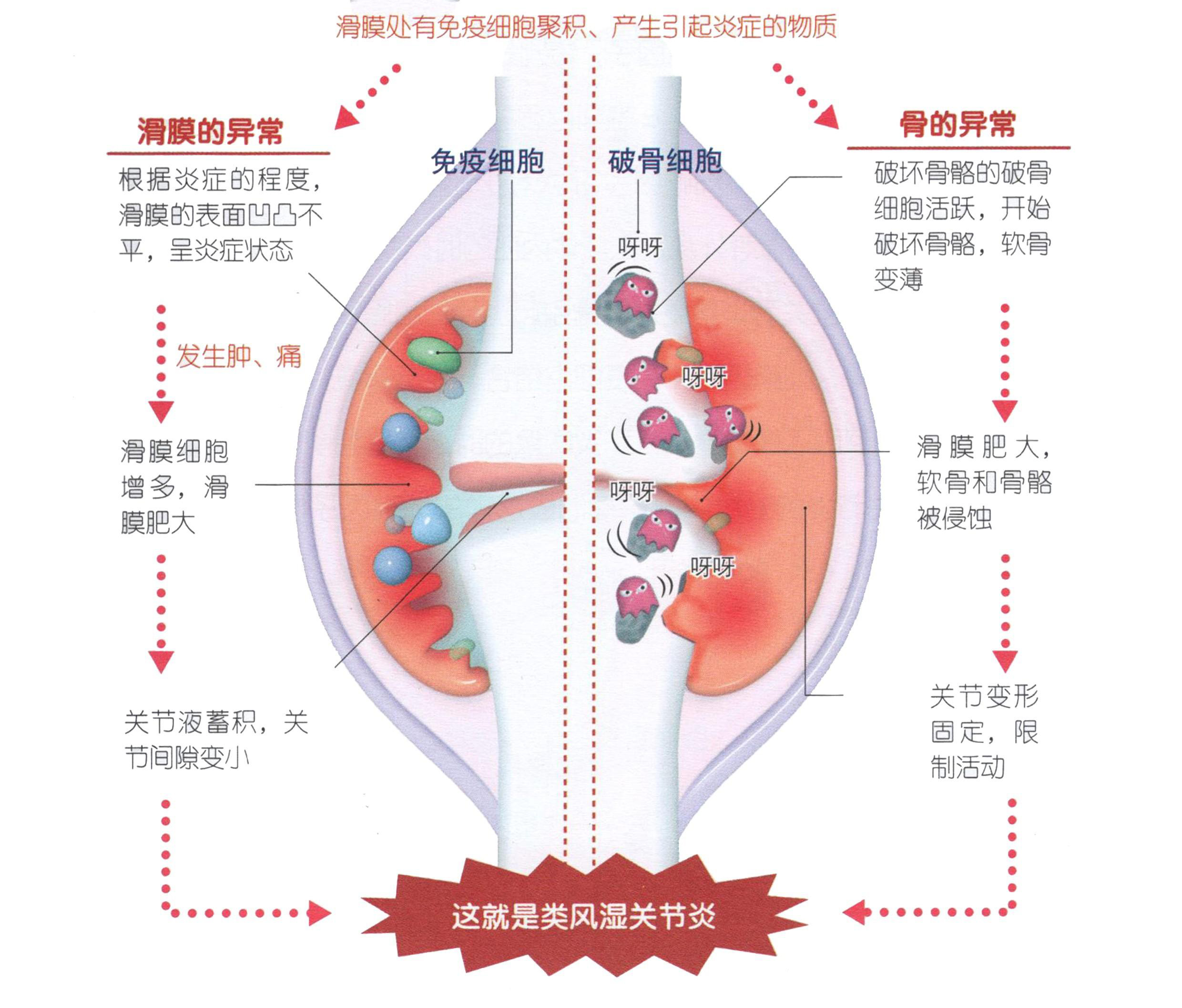类风湿因子正常,血沉,c反应蛋白高,手指痛是类风湿关节炎吗?