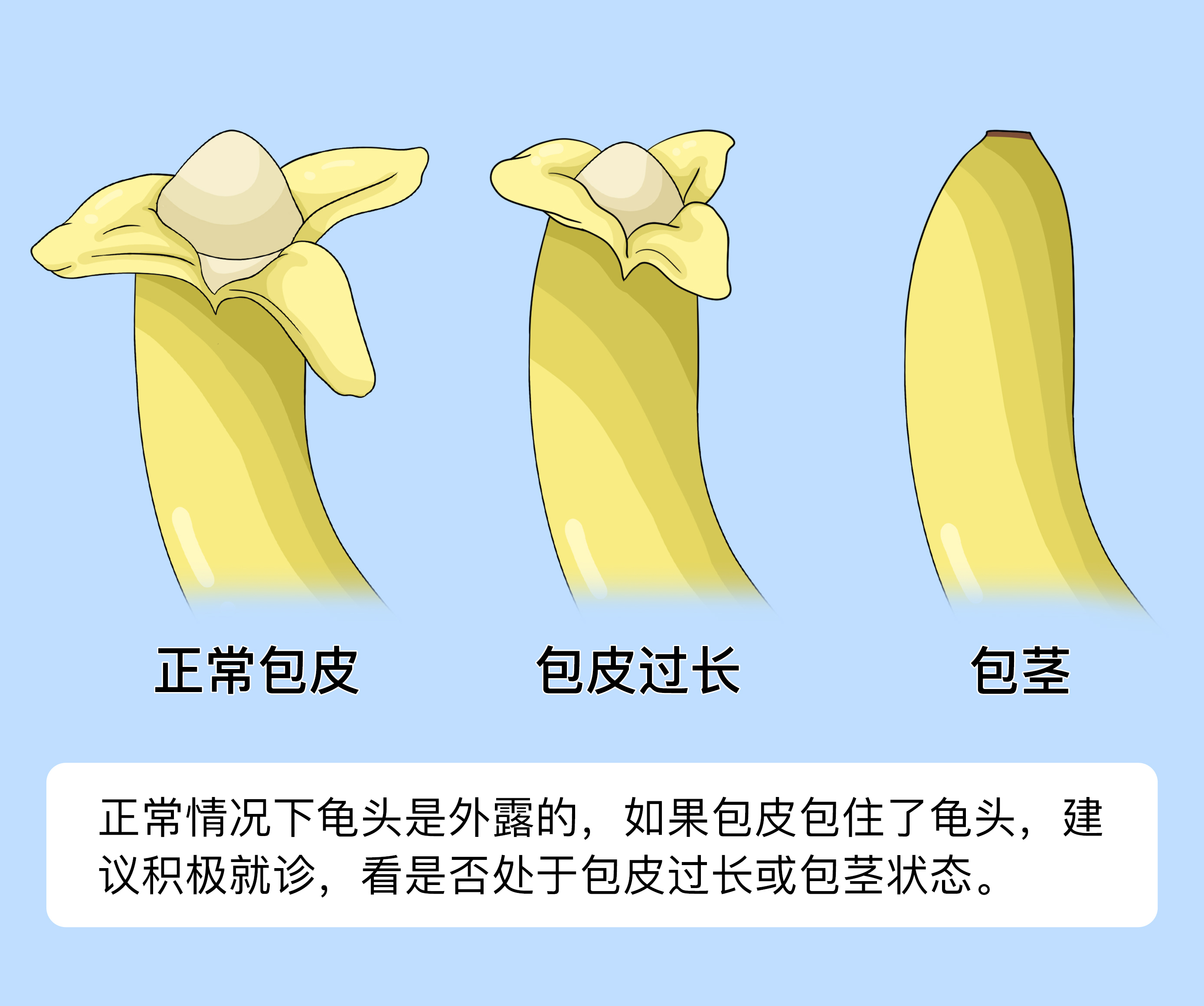 包皮过长或包茎是否会引起其他健康问题
