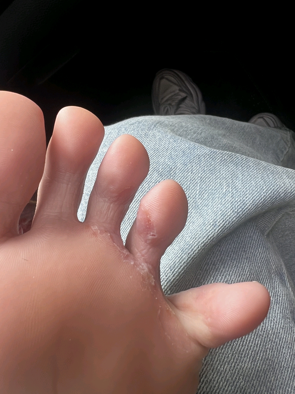 脱皮,脚趾缝有时溃烂,痒,有异味.有可能是得了脚癣,俗称"香港脚"