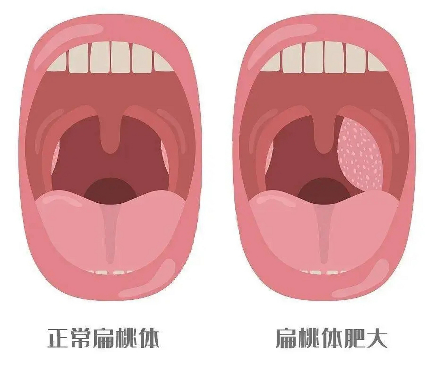 一个彻底解决孩子鼻炎腺样体肥大的中药方子,可以保存!