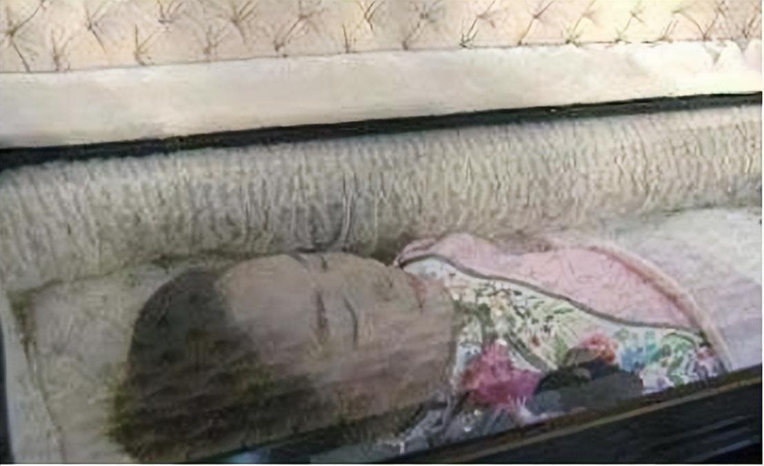 最终因为抢救不及时,加上使用了过量的扩张喷剂,邓丽君脑部部出现重度