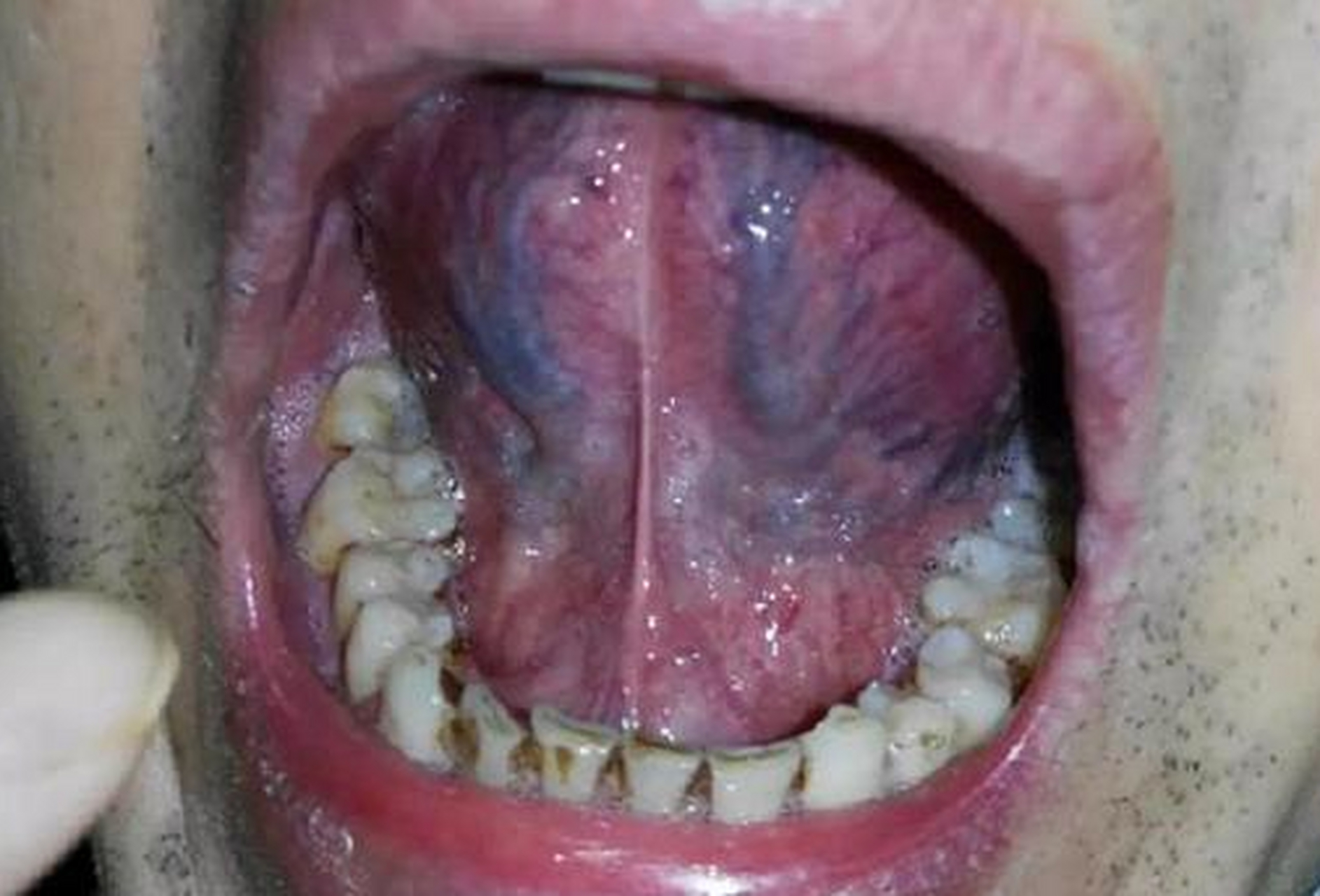 舌下青筋黑又粗,十有八九是淤堵!