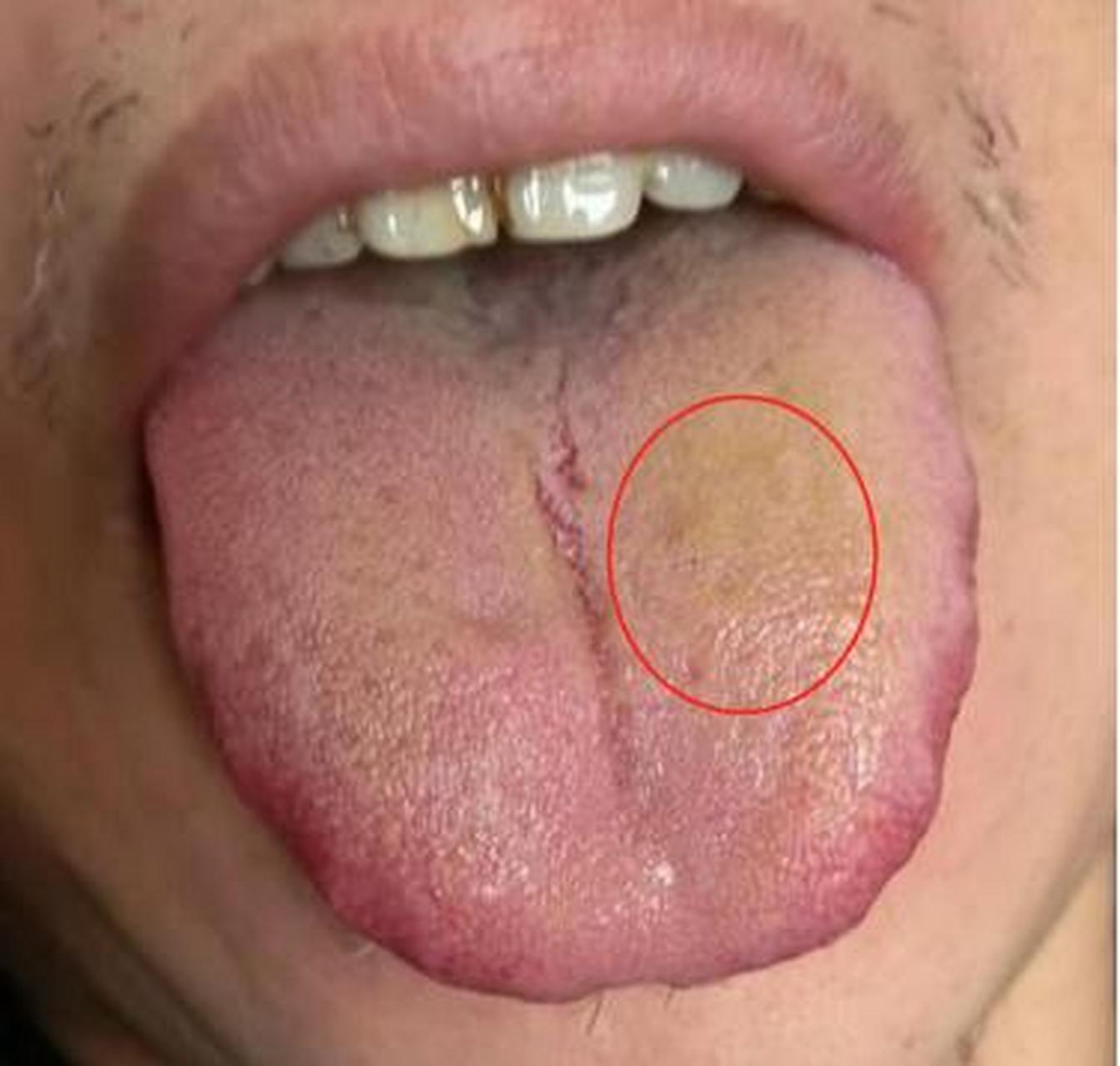 见到这种舌苔,只需谨记一句:清湿,清热,清湿热,清肝胆湿热!