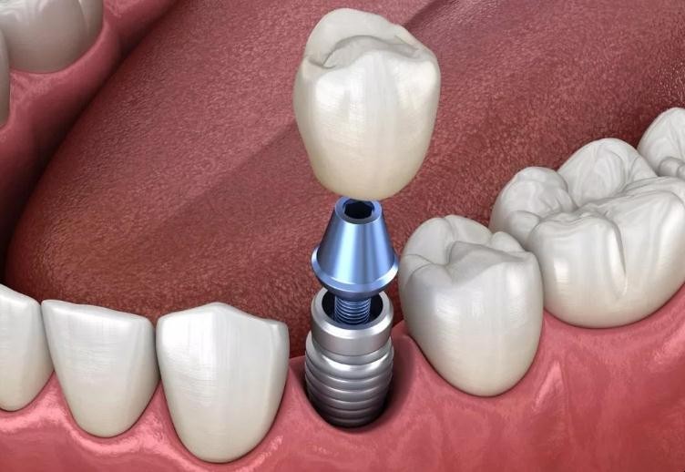 一文帮你理清真牙和种植牙的区别