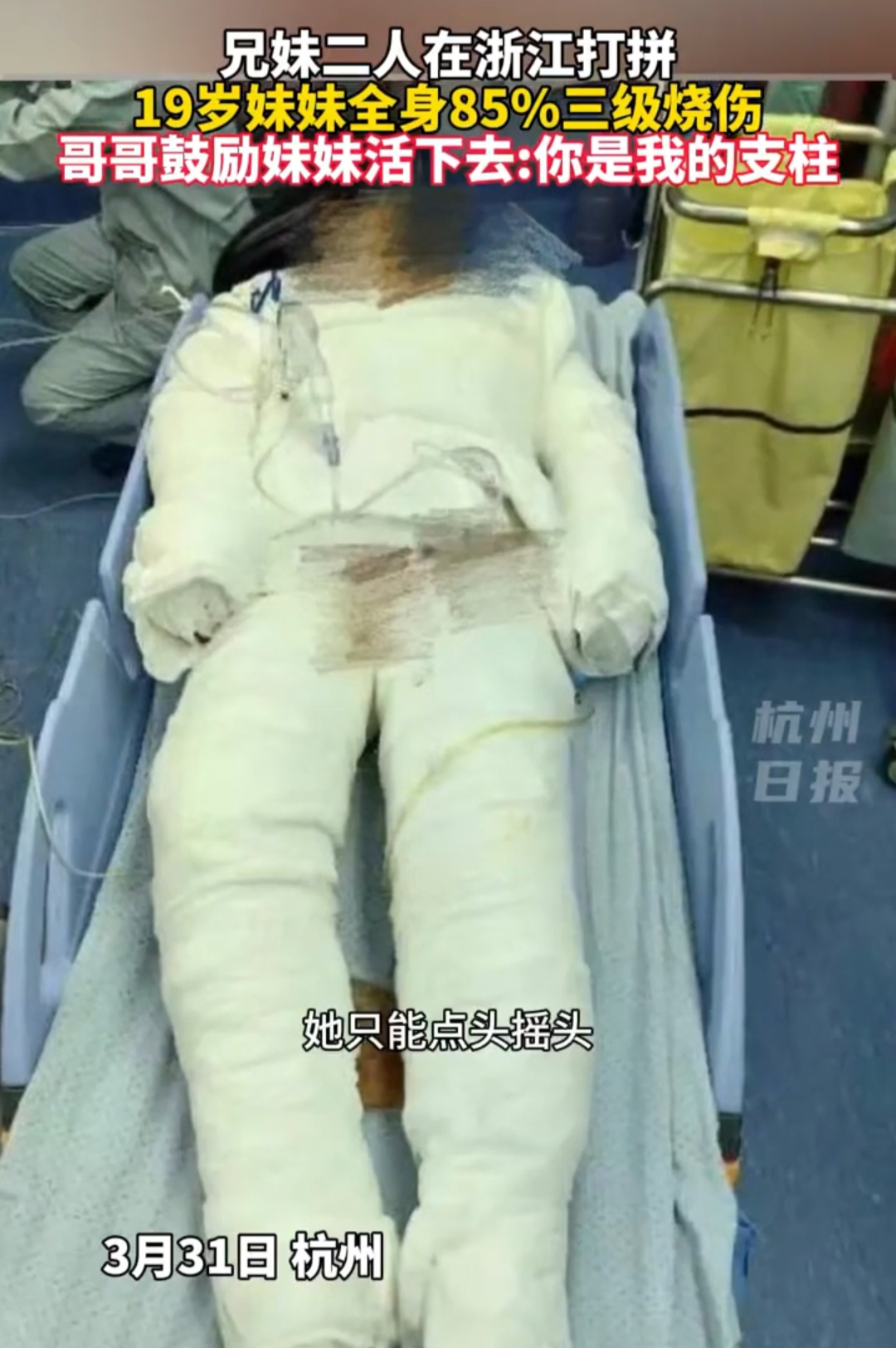 19岁女孩全身85%烧伤,治疗费用需上百万,一天内收到捐款150万
