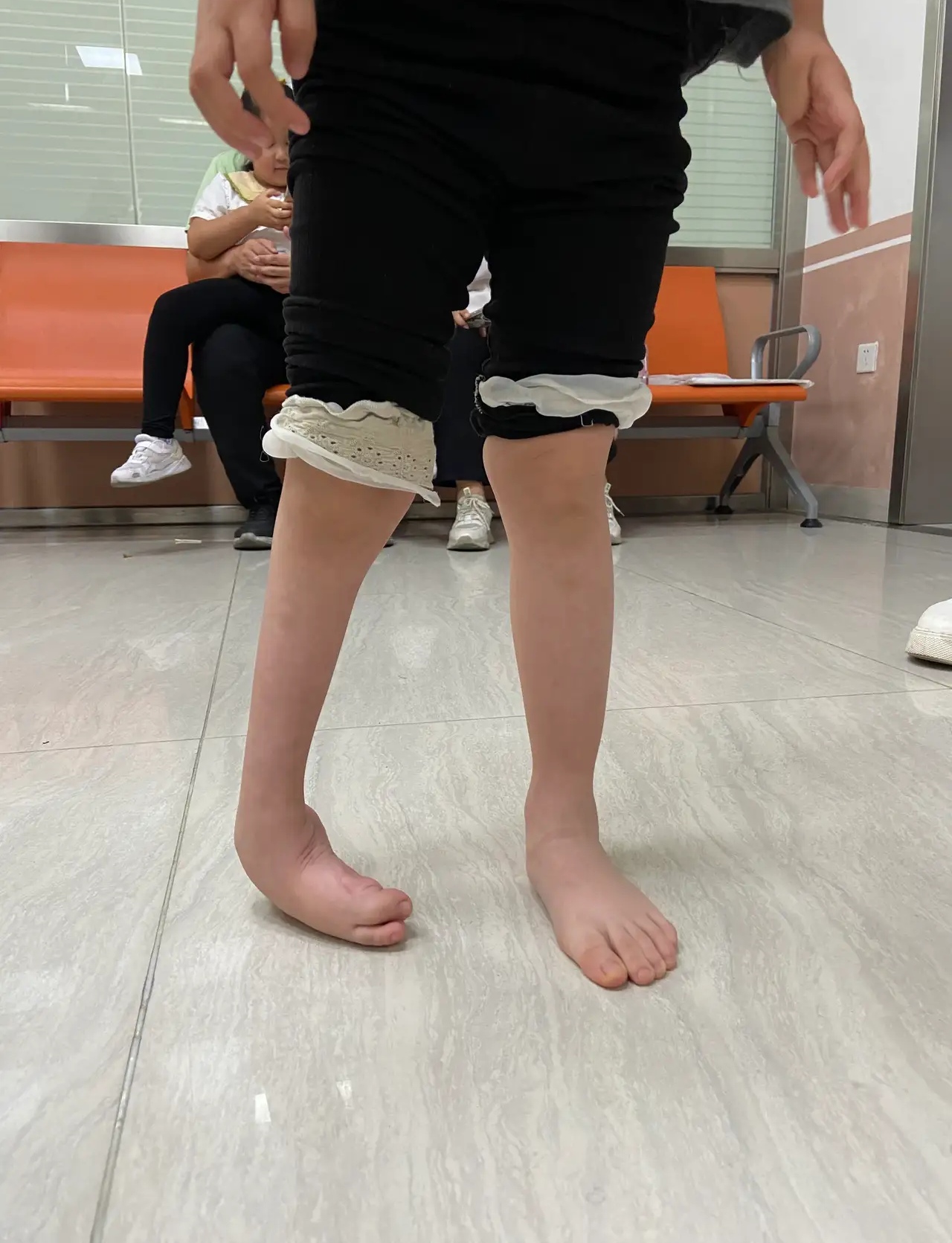 5岁女孩,右脚马蹄内翻足,从出生的时候就这样,家住云南,市区的医院没