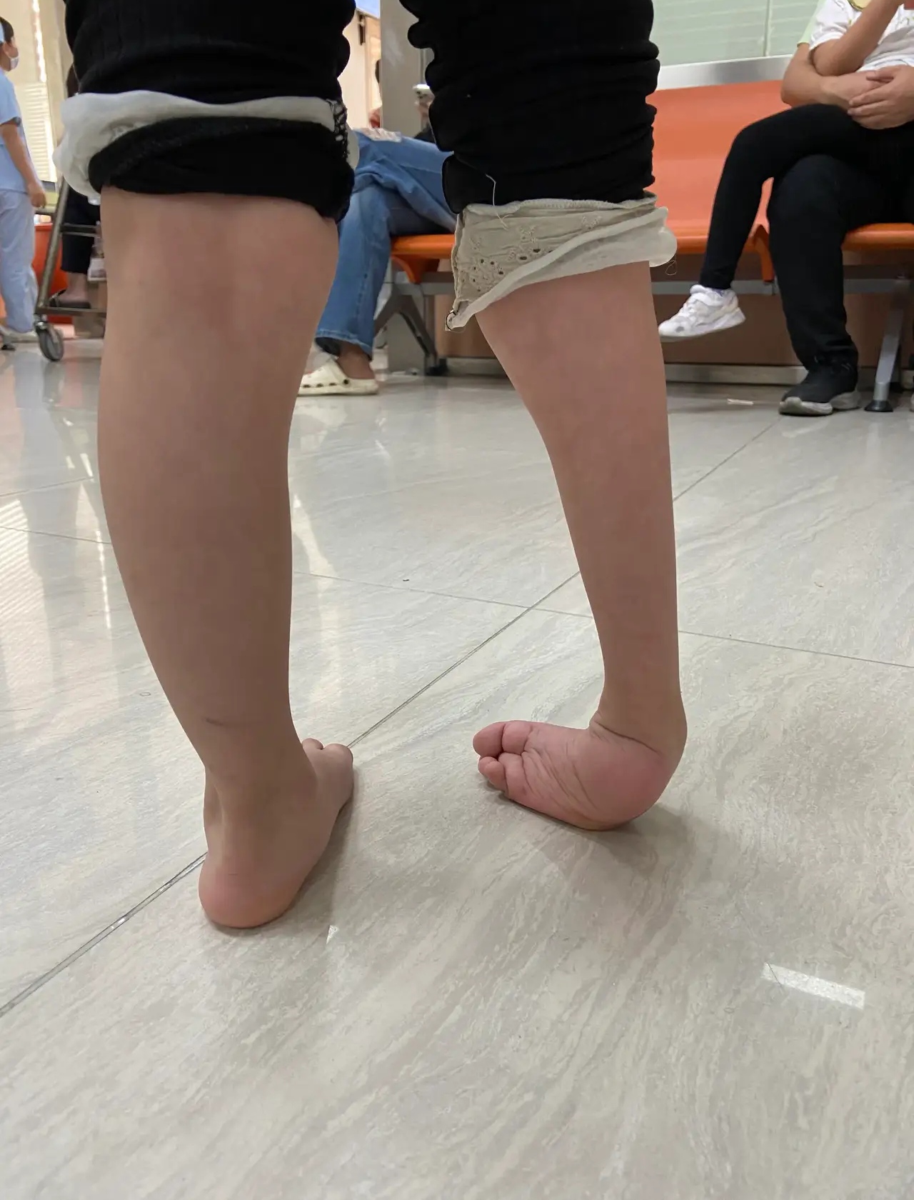 5岁女孩,右脚马蹄内翻足,从出生的时候就这样,家住云南,市区的医院没