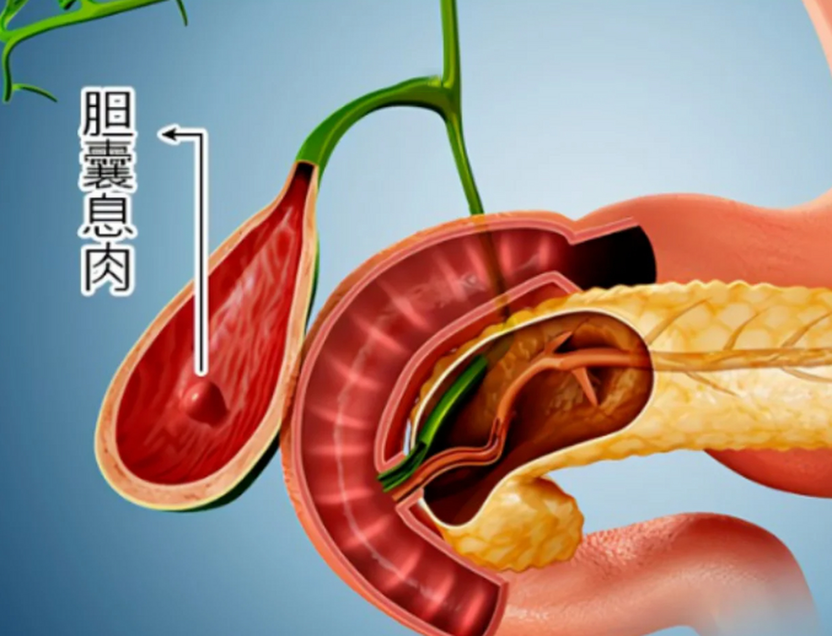 胆囊息肉,我不建议手术切除!