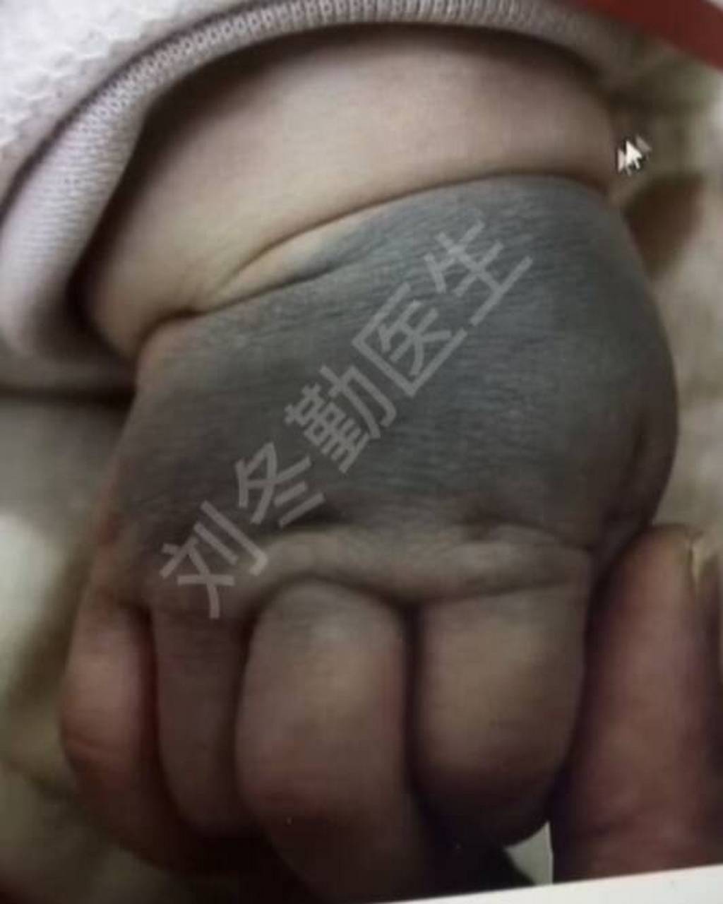 这个太田痣宝宝三个月大了,刚出生时手上就有个淡淡的青色印记,家长