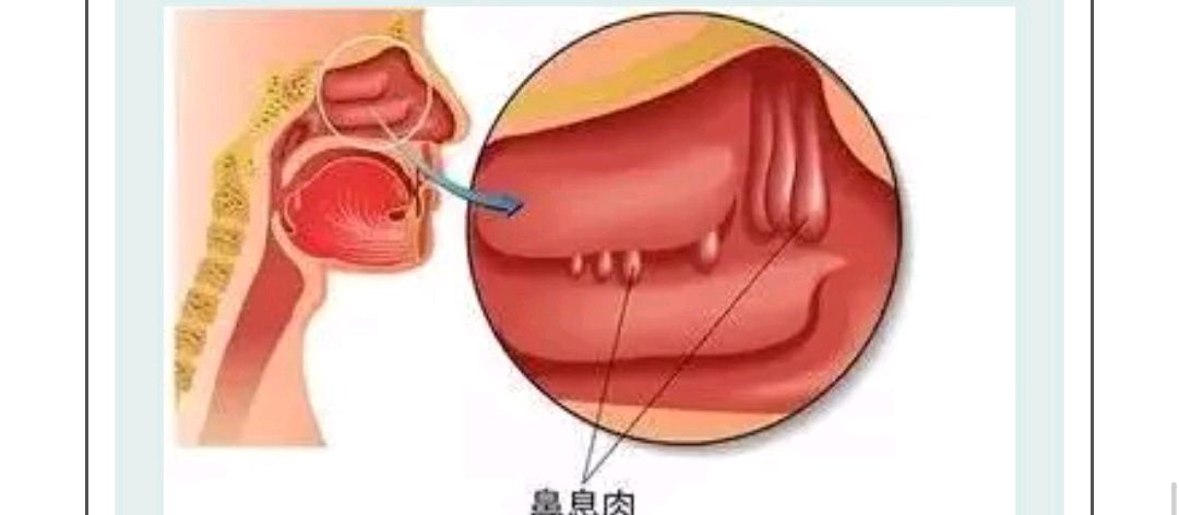 鼻息肉初期图片图片