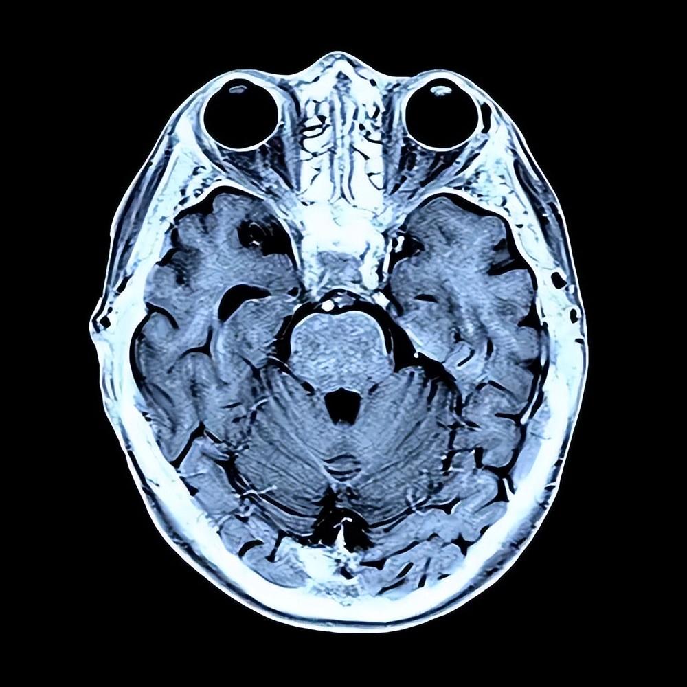 脑部核磁共振片子图片