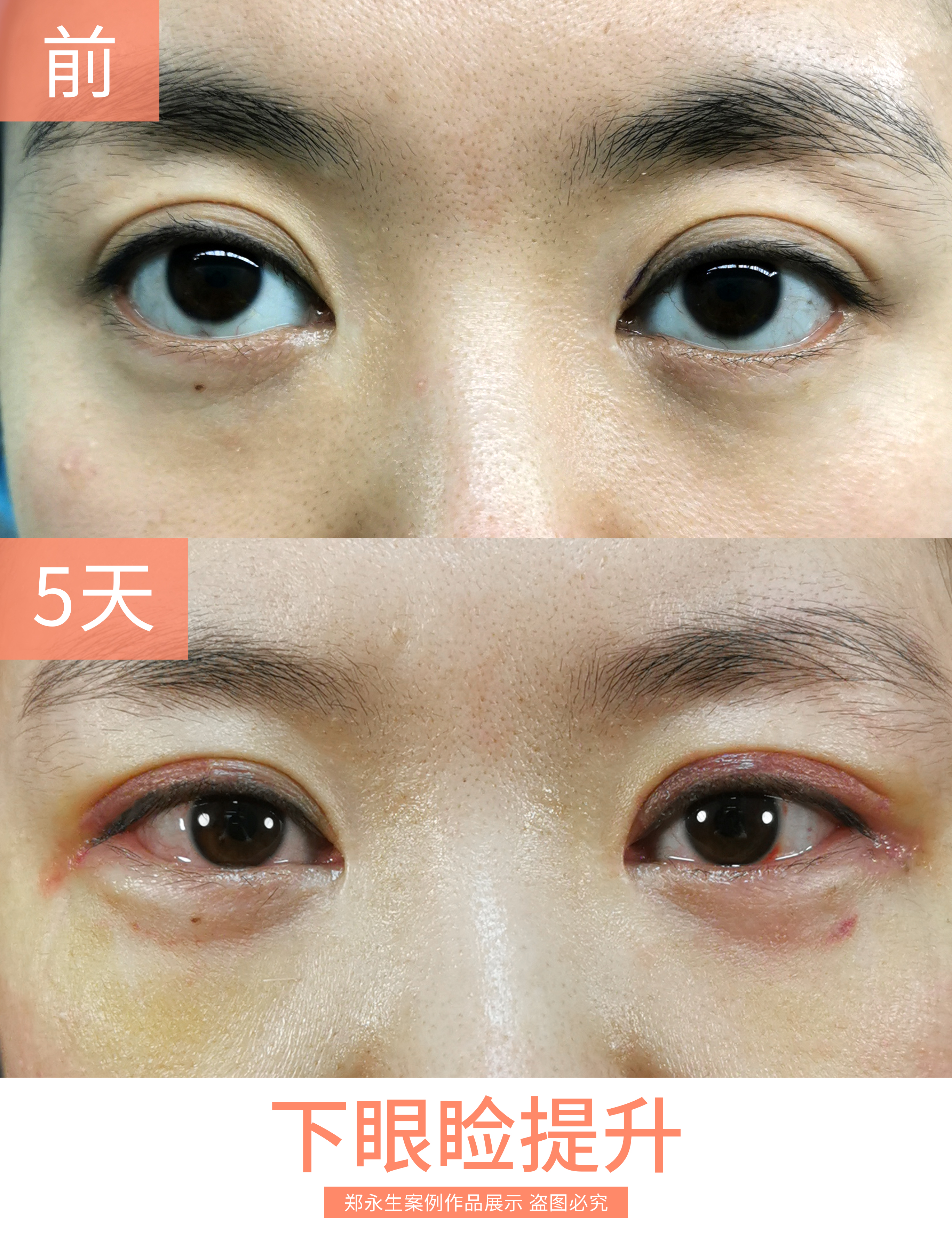 30岁做下睑退缩术后1.@整形修复医生郑永生的动态
