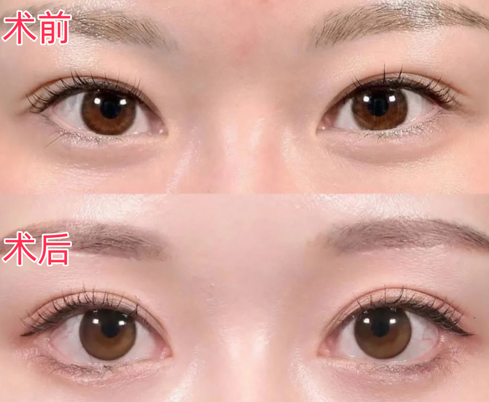 "吊眼"的改善 吊眼又称上斜眼.