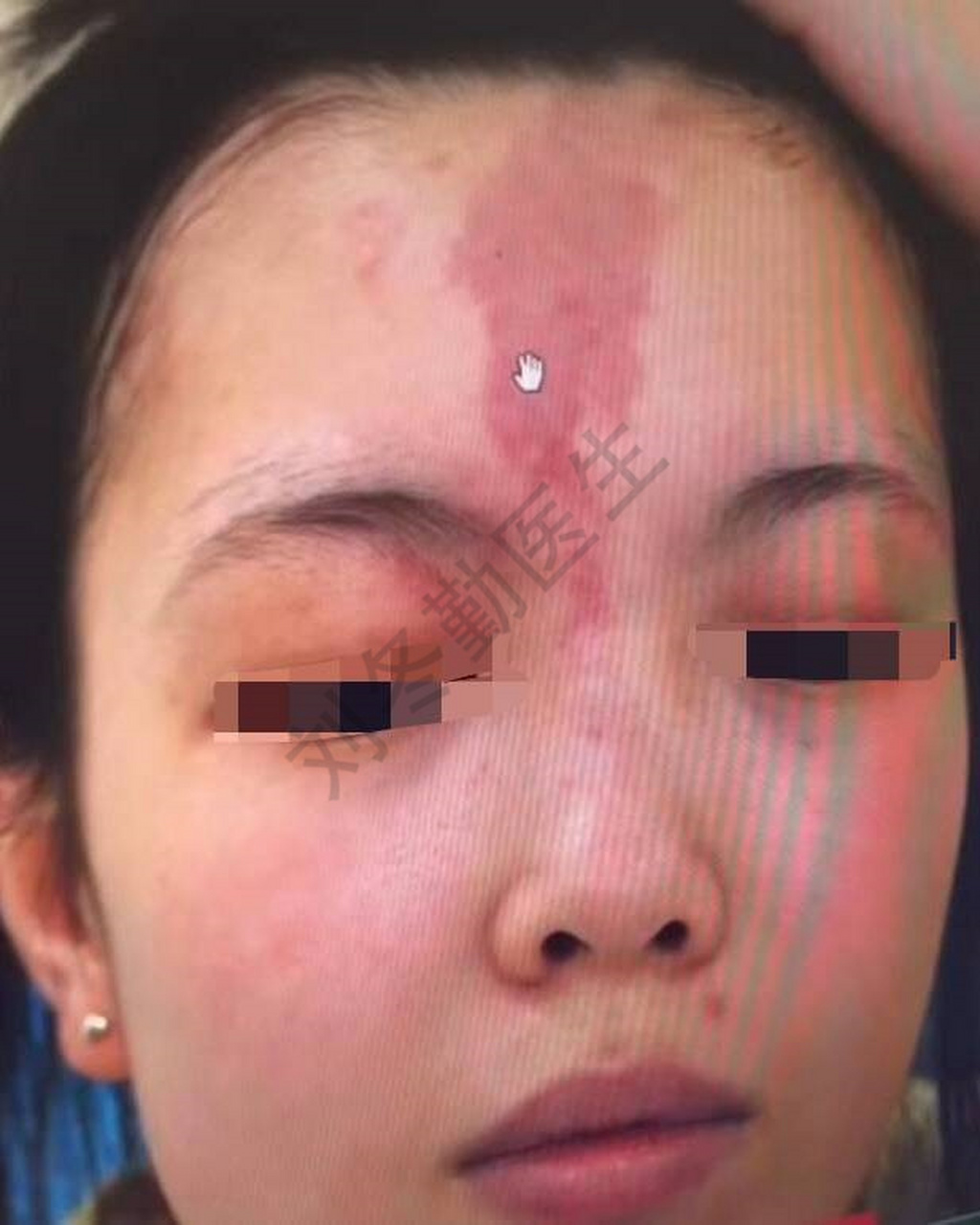 可以看到这位女士额头上红斑一片,按压时会褪色,目前发展到第二期,跑