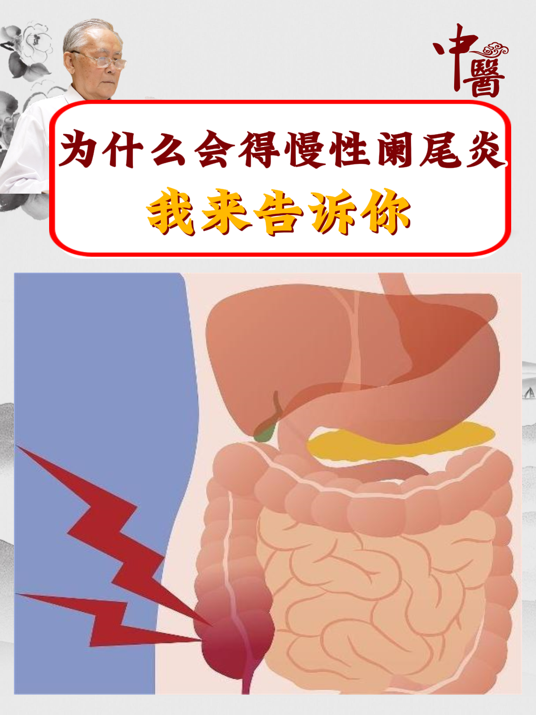 阑尾炎 为什么会得慢性阑尾炎我来告诉你