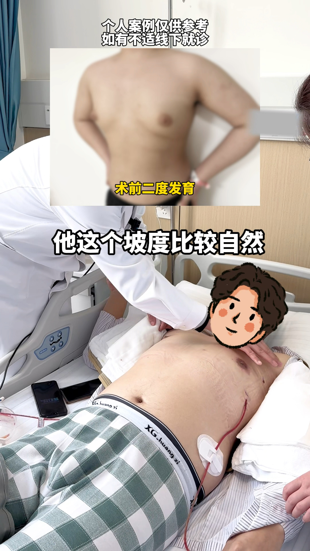 男性乳腺发育