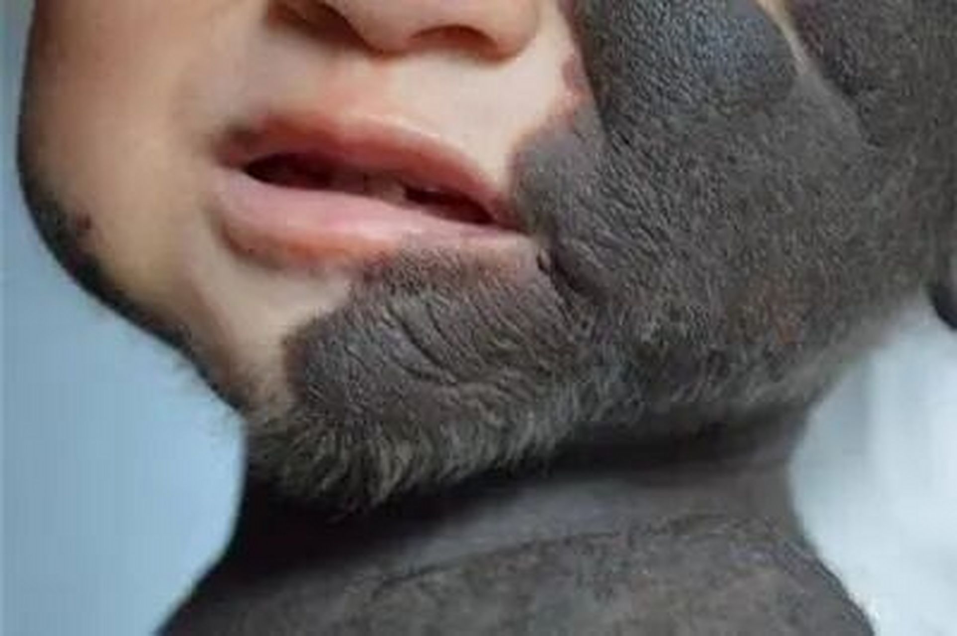 兽皮痣是先天性黑素细胞痣的一种,就跟原始人披在身上的兽皮差不多,但