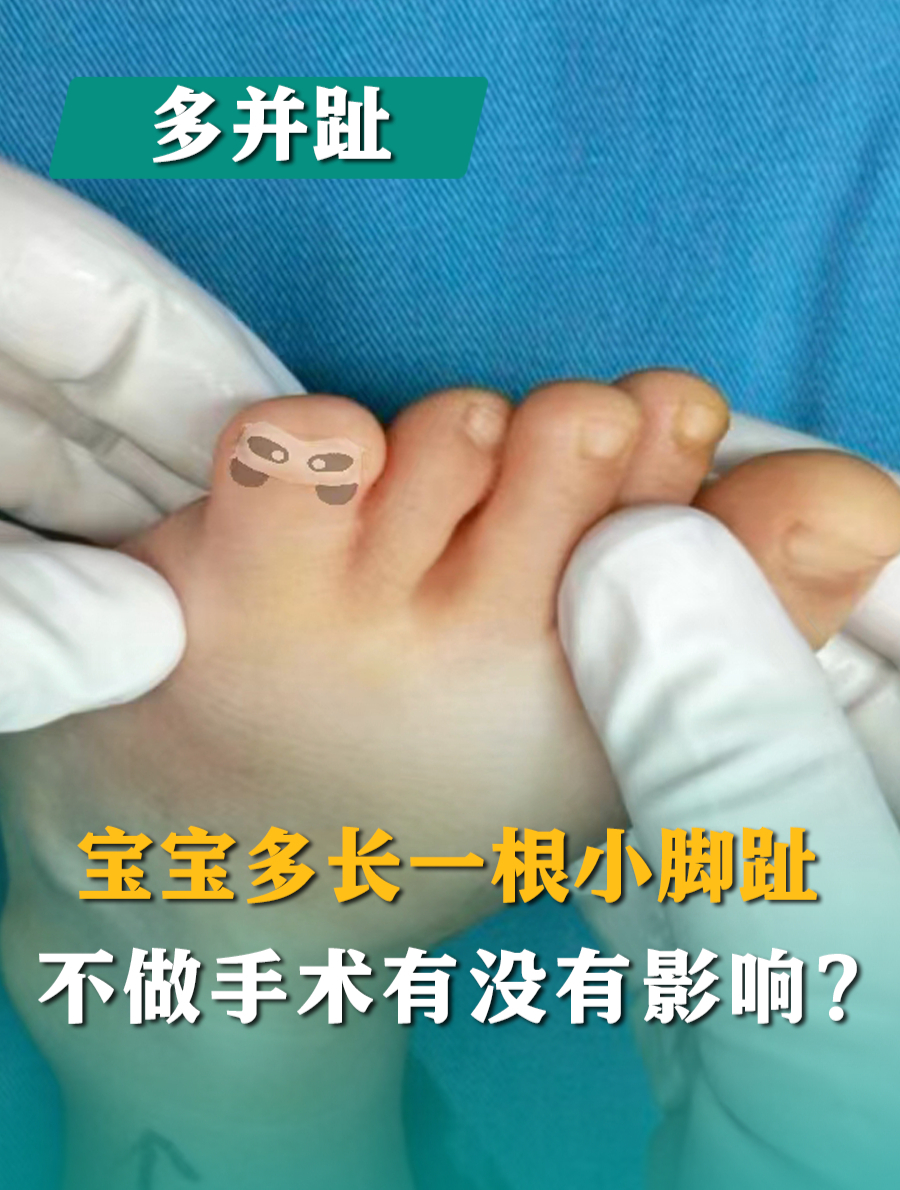 3岁男孩小趾多并趾,很粗,术后6个月活动没问题,妈妈再也不担心
