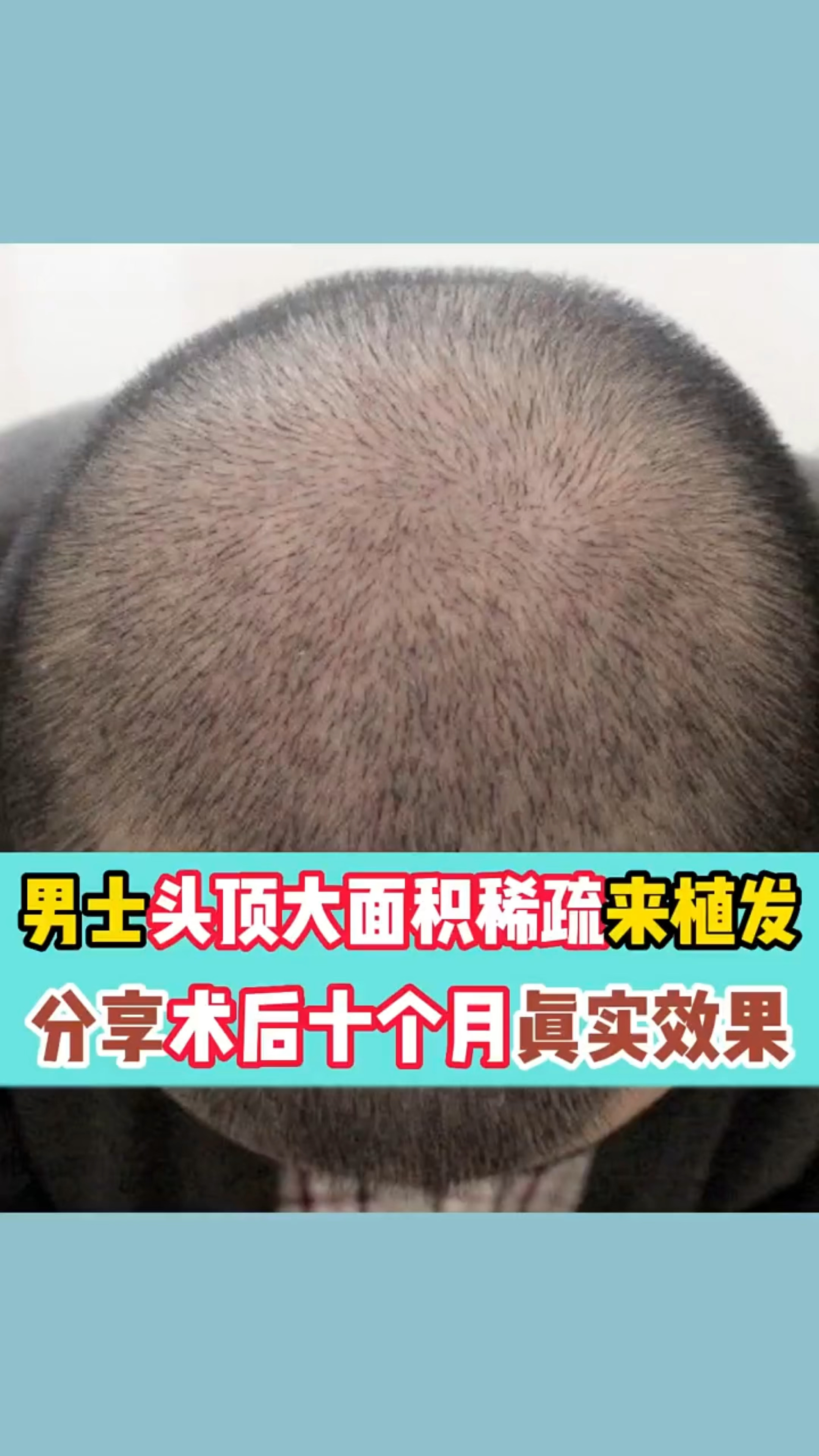 男性植发的原理(男性植发的原理和过程)