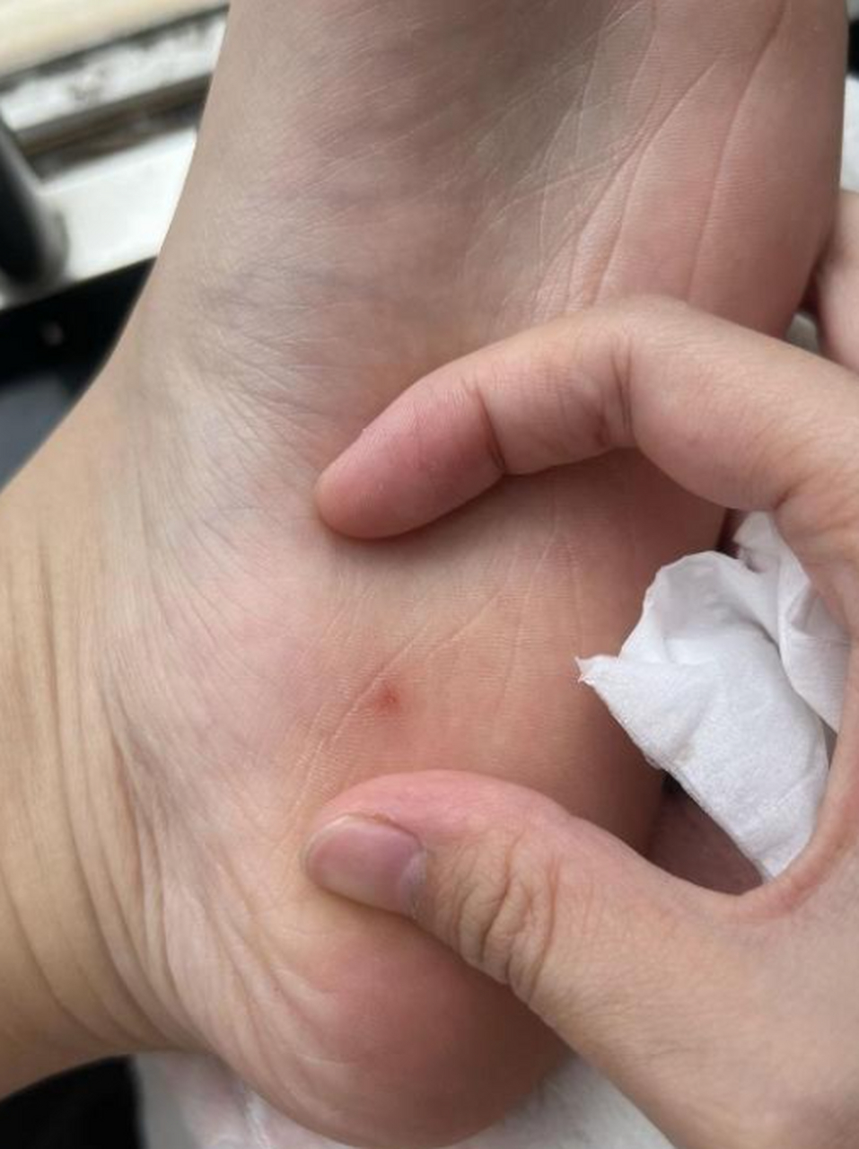 用这个伤请假老板会批准吗