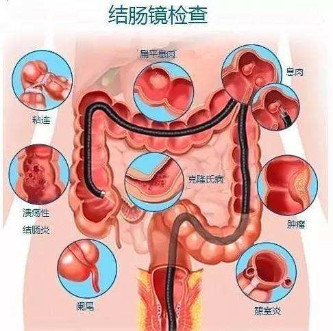 痔疮嵌顿什么意思图片