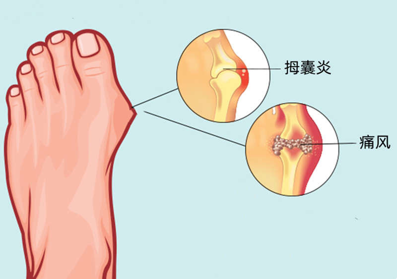 脚后跟疼是痛风吗图片