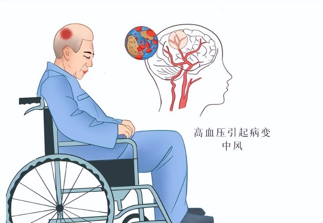 回顾为什么东北地区半身不遂的人比较多背后有什么原因