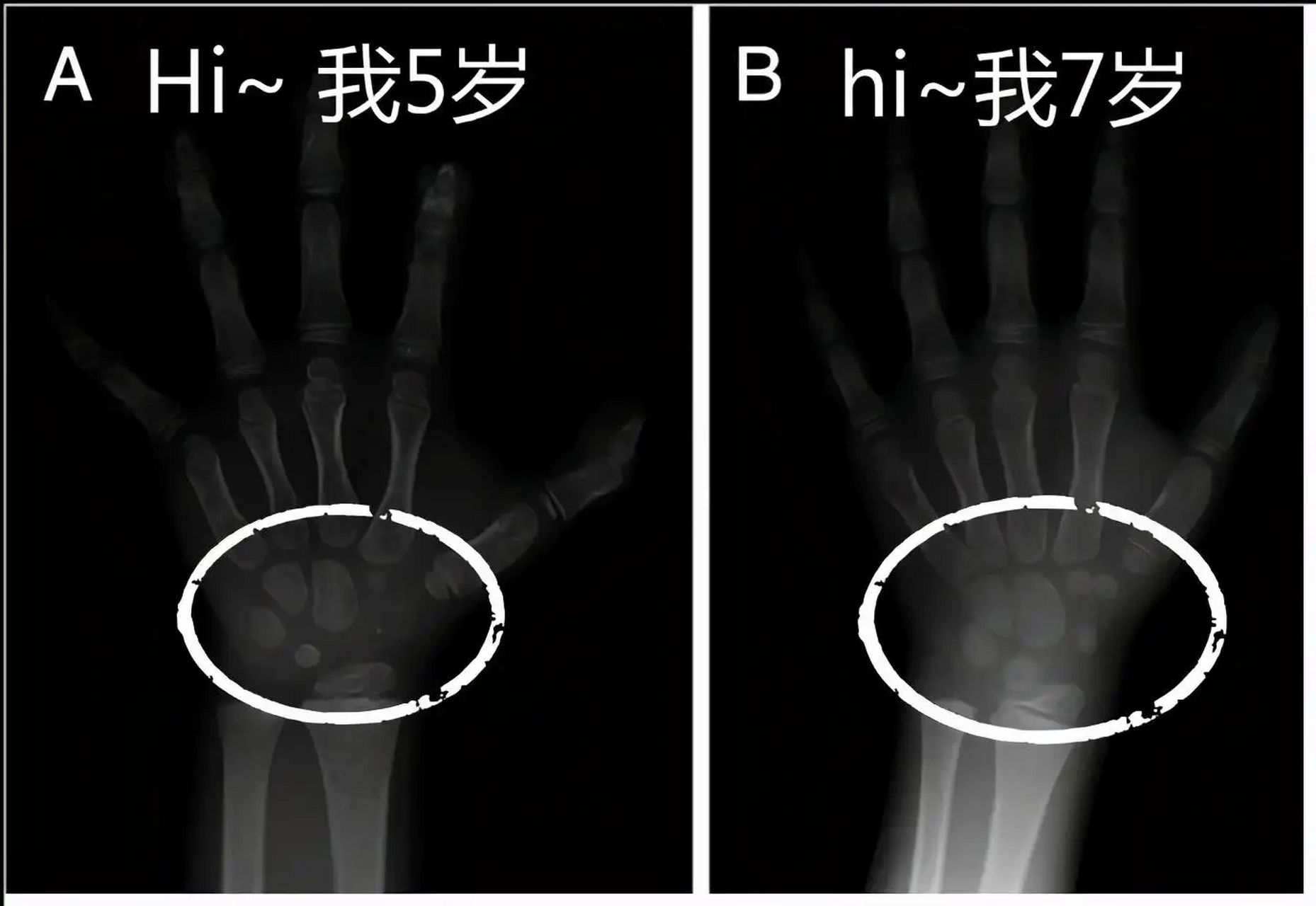 骨龄片子怎么看左手图片