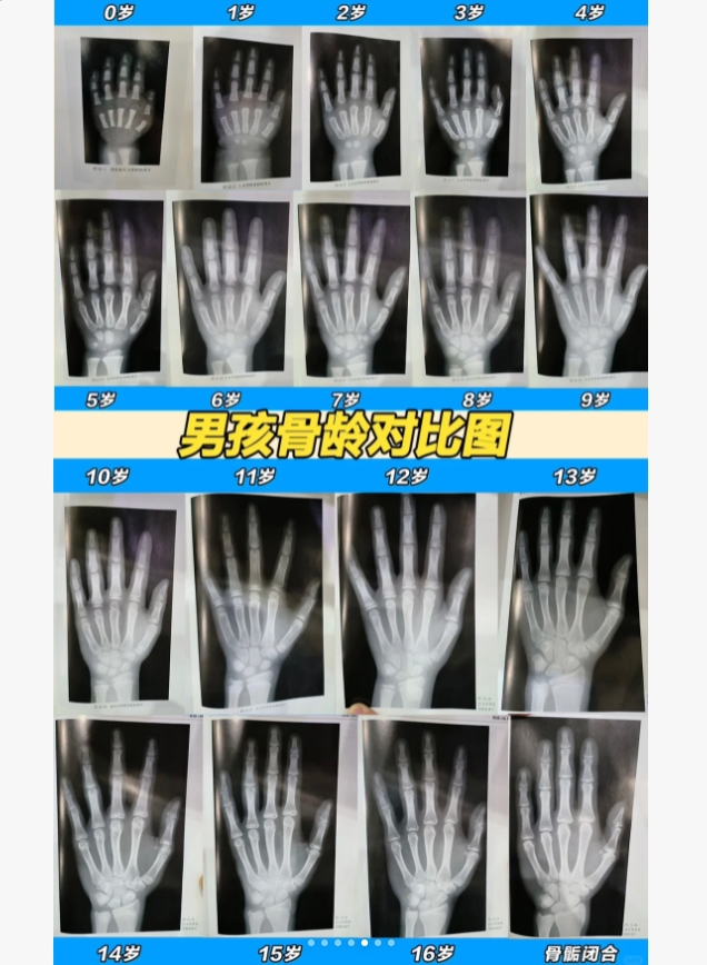 骨龄片到底怎么看?