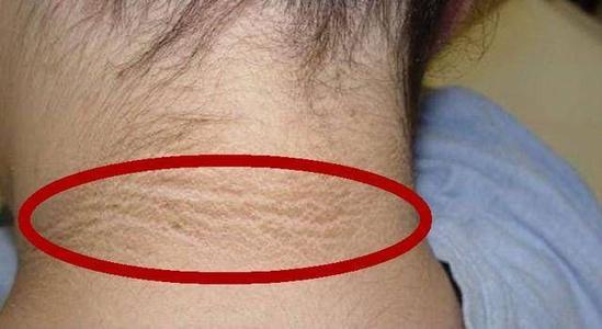 若此现象与体重过重同时出现,那我们应高度关注是否患有与肥胖相关的