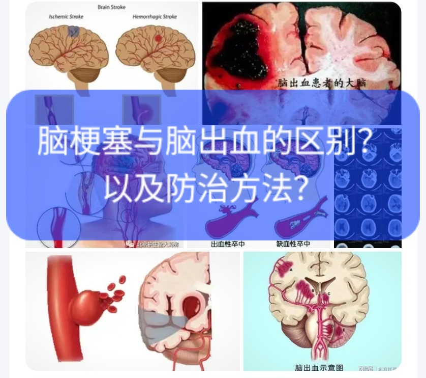 脑梗塞与脑出血的区别?以及防治方法?