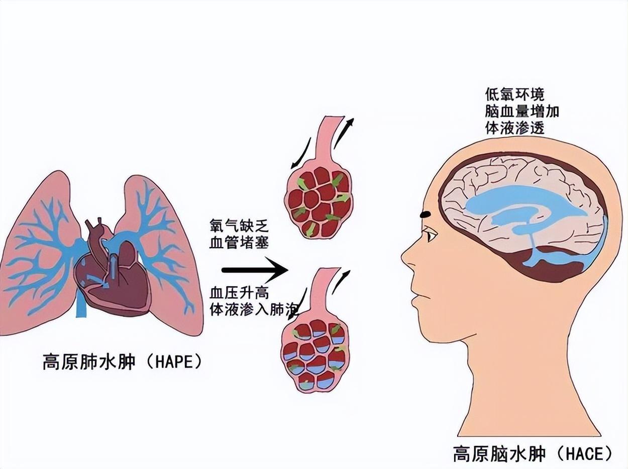 高原旅行游客注意缺氧会危及生命急性高原病该如何救治预防