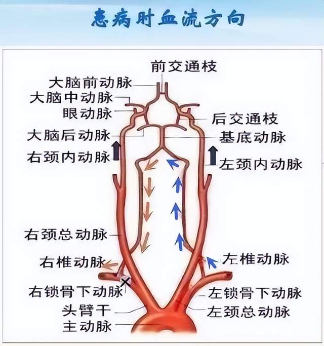 锁骨下动脉分段的标志图片