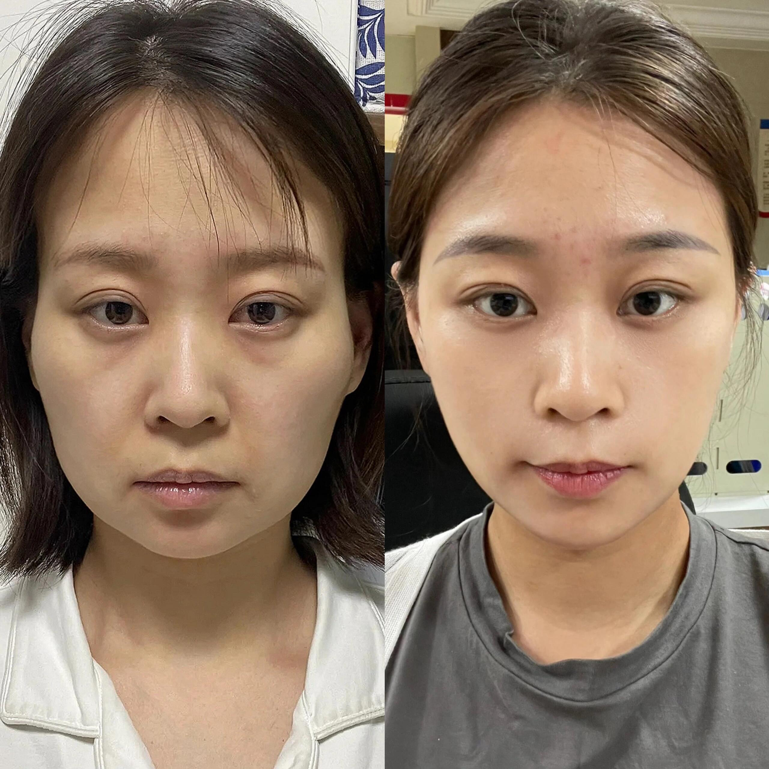 照片面部凹陷对比图脸下垂前后对比图片颧骨凹陷太阳凹陷颧骨高怎么整