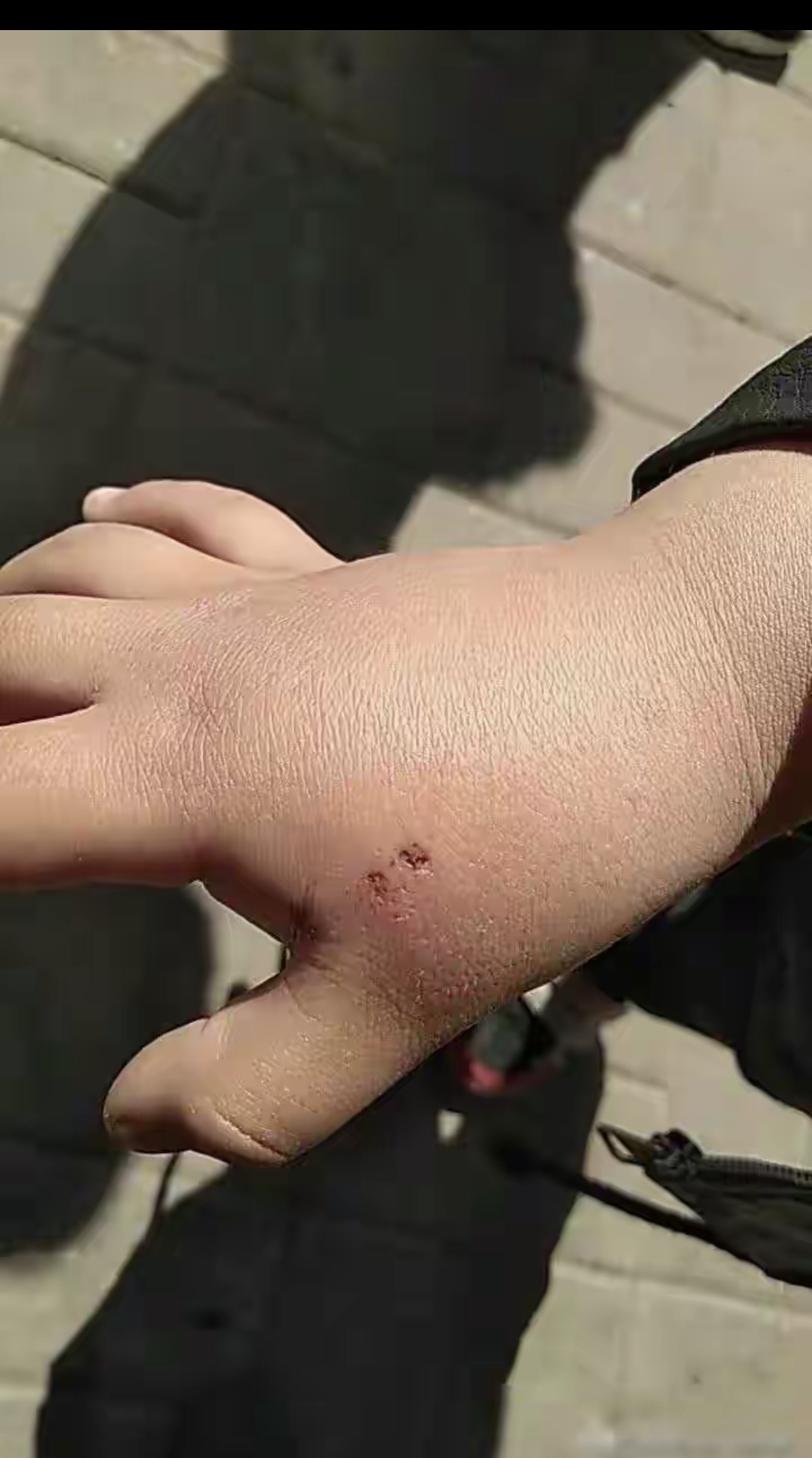 嘿,听说我爷爷以前被老鼠咬了手,肿得跟个大馒头似的,吓得赶紧去了