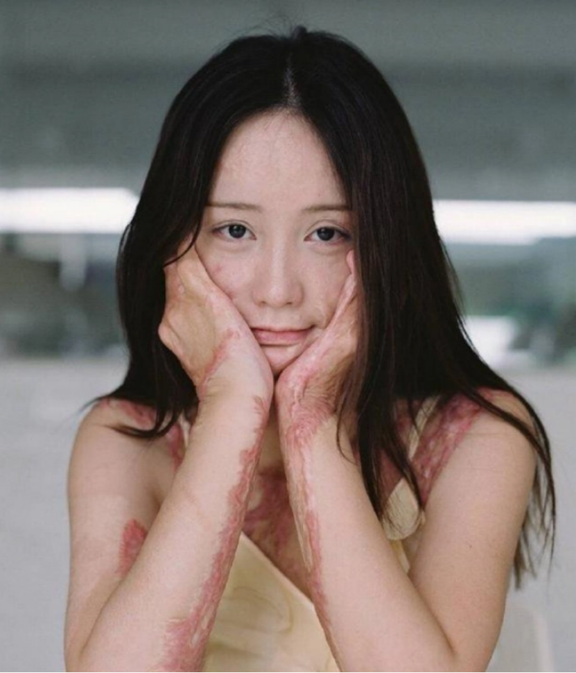 2011年合肥16岁少女遭官二代求爱不成纵火毁容如今她还好吗