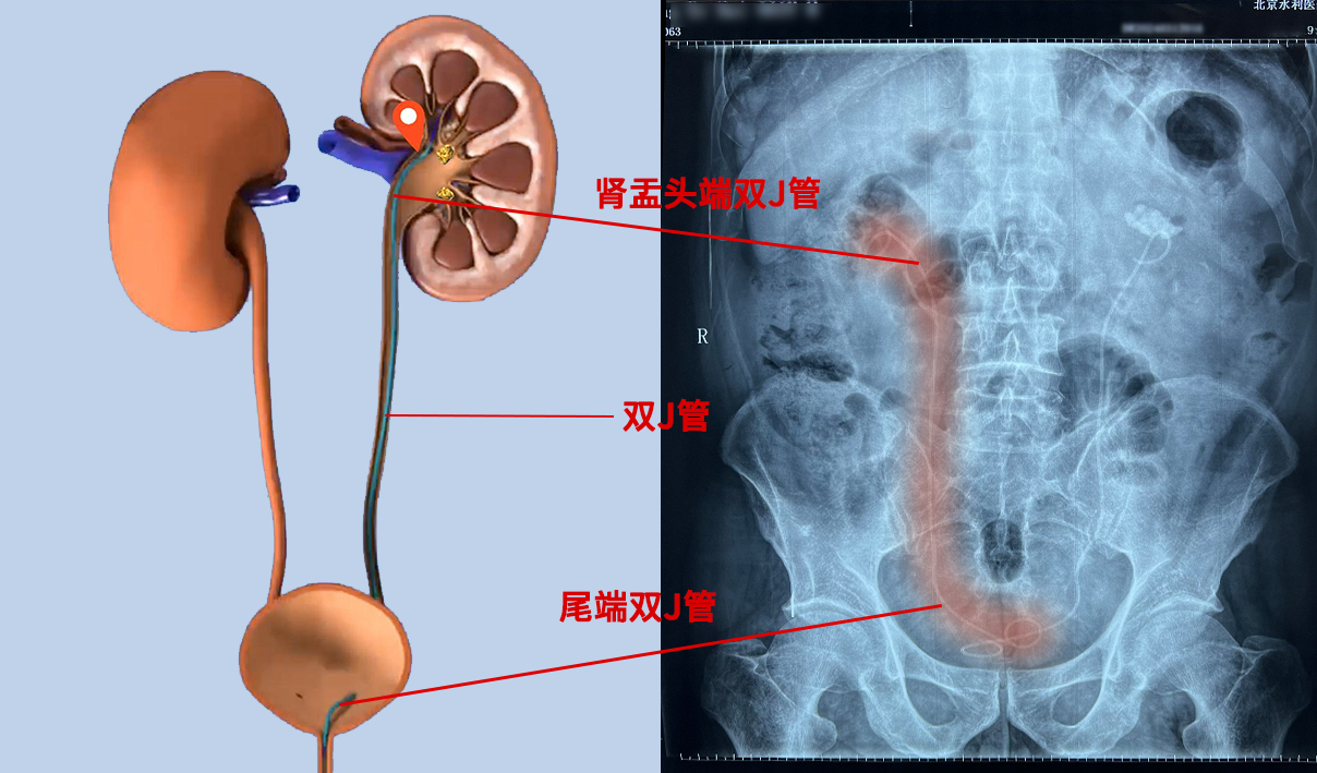 双J管示意图图片