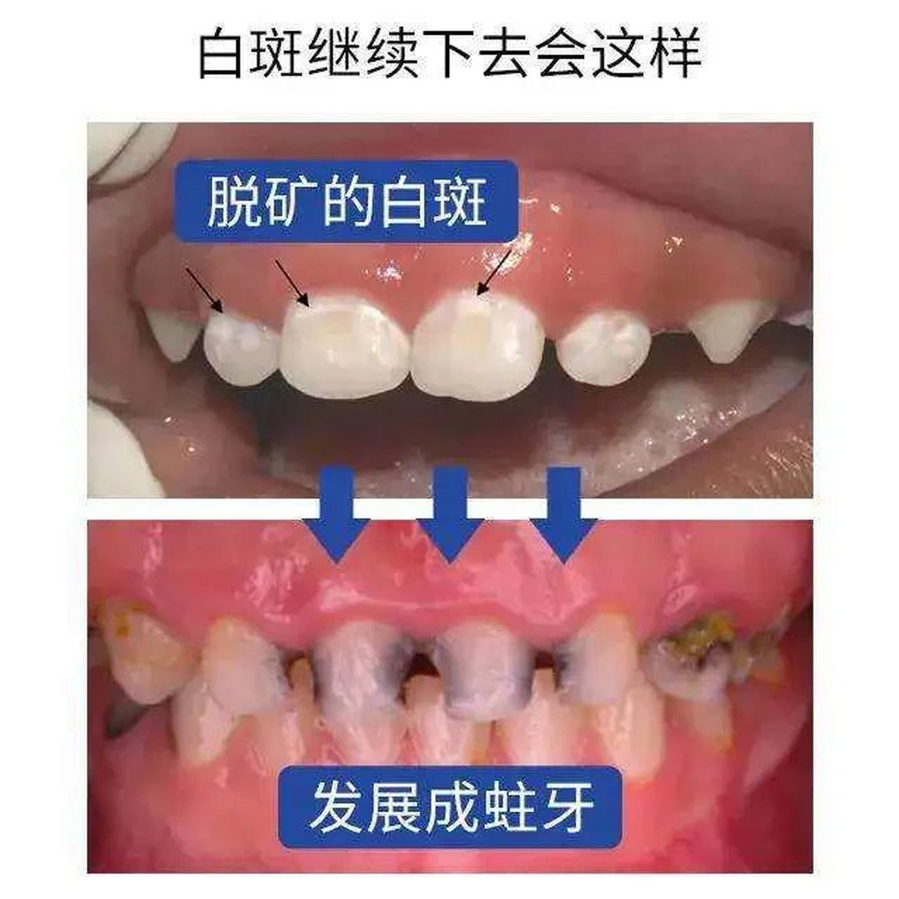 儿童牙齿钙化的原因图片