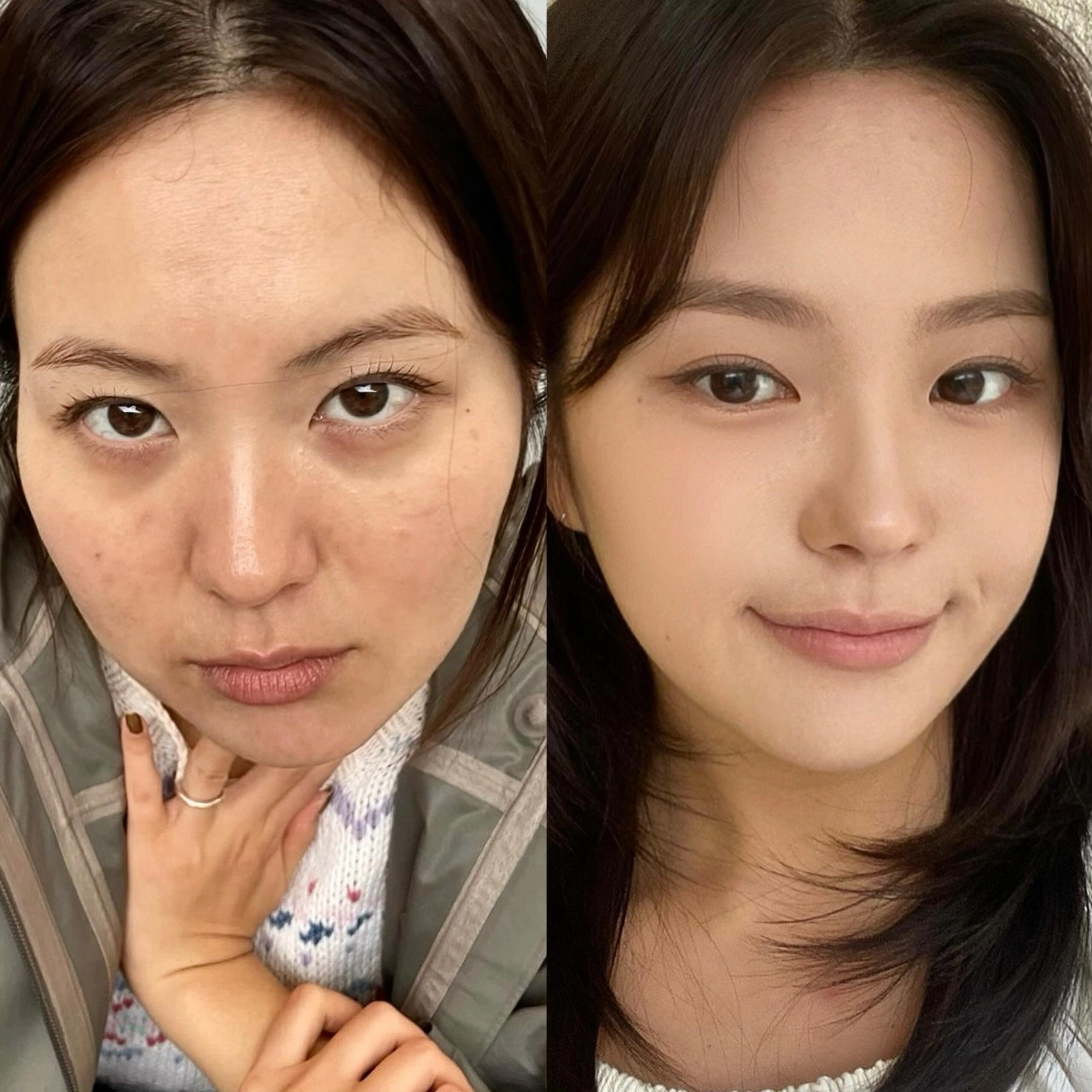 没有压力下的对比图片毛孔缩小前后淡化色沉拿老公4个月工资做的微调