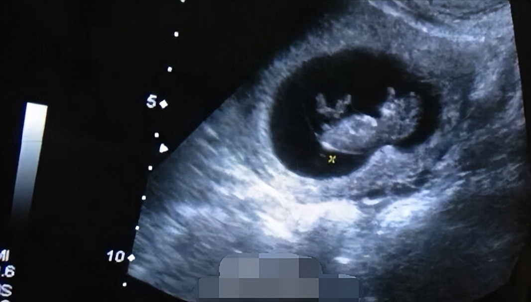 初中生怀孕大肚子图片