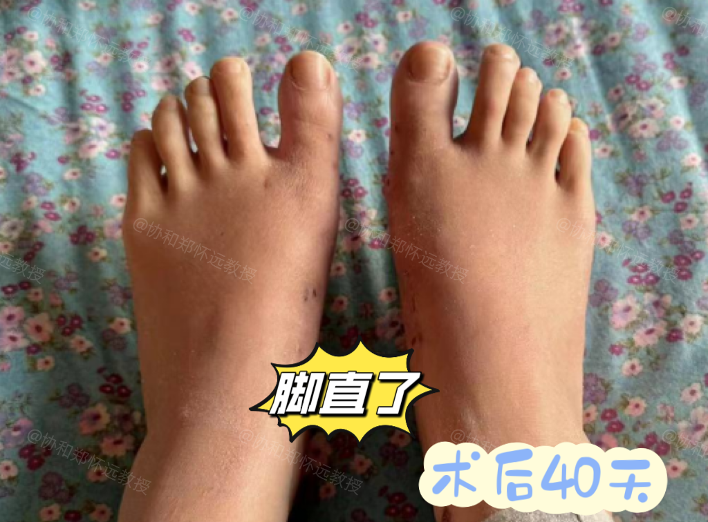脚痛的现象大脚趾腱鞘炎图片脚部腱鞘为什么女性比男性更容易得拇外翻