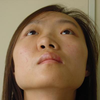 修复后呼吸通畅,五官端正,好朋友到家去看她,说完全看不出之前鼻子歪