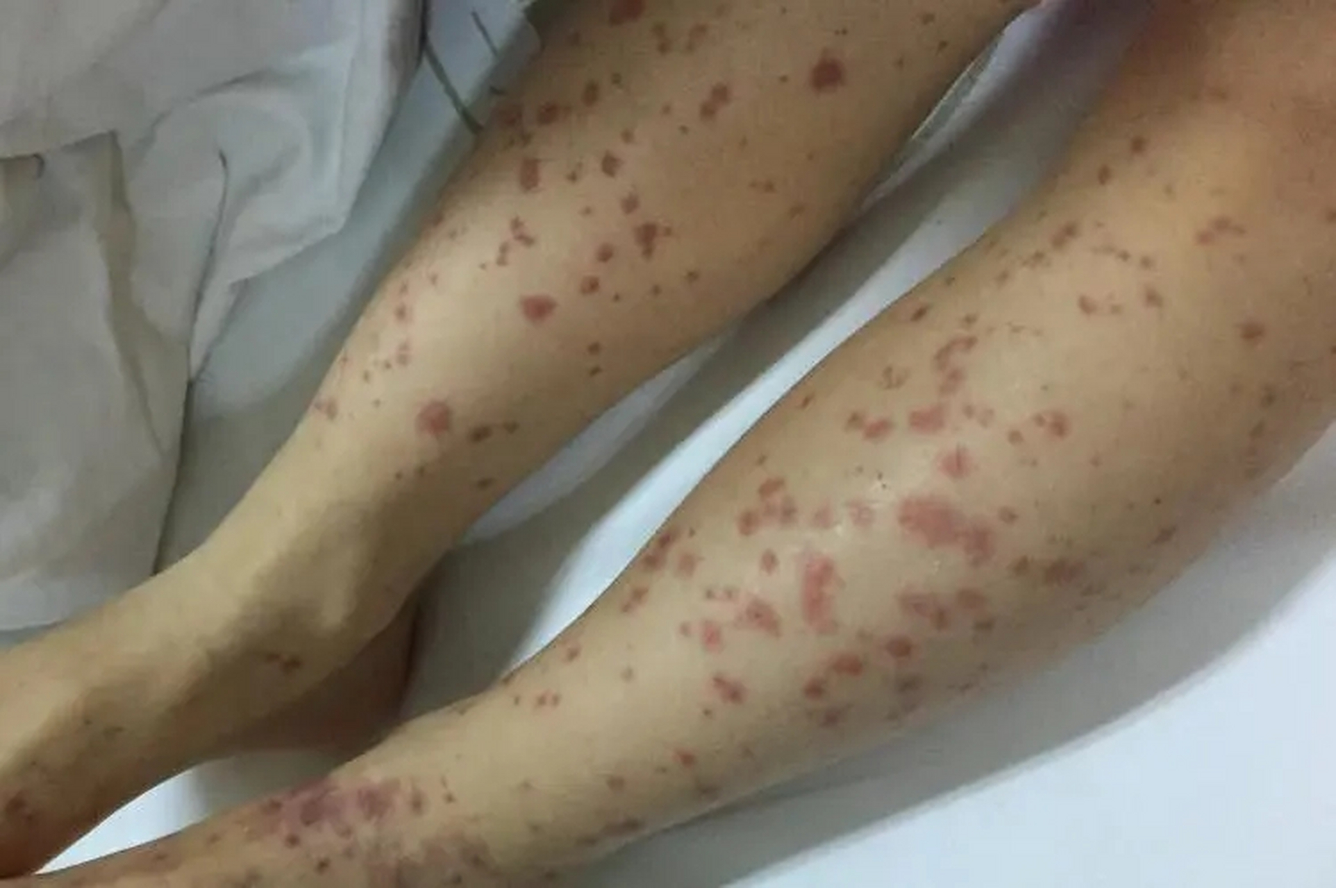 像图中这种压着不褪色的是过敏性紫癜,这种一般在小孩子身上更多见