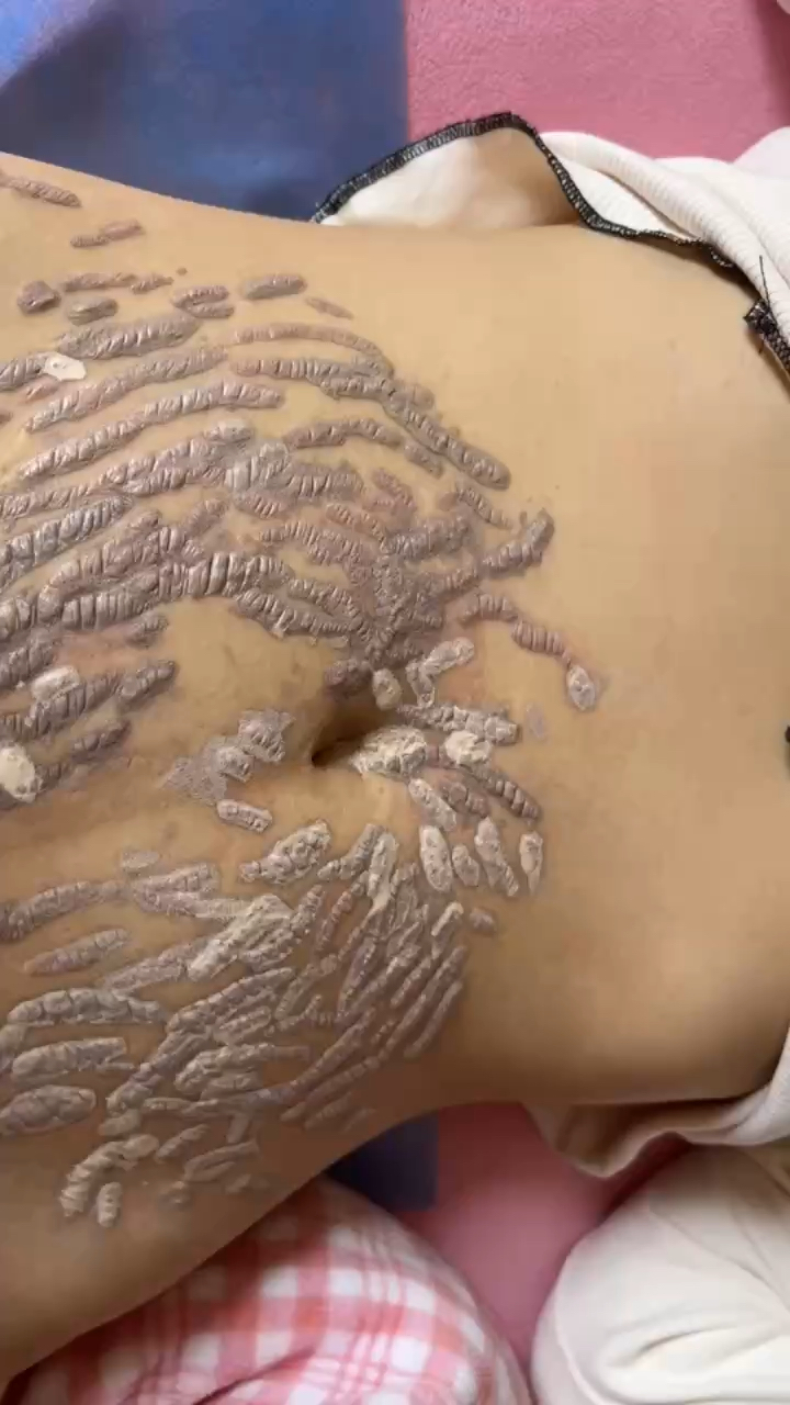 专业的事情请交给专业的人,妊娠纹