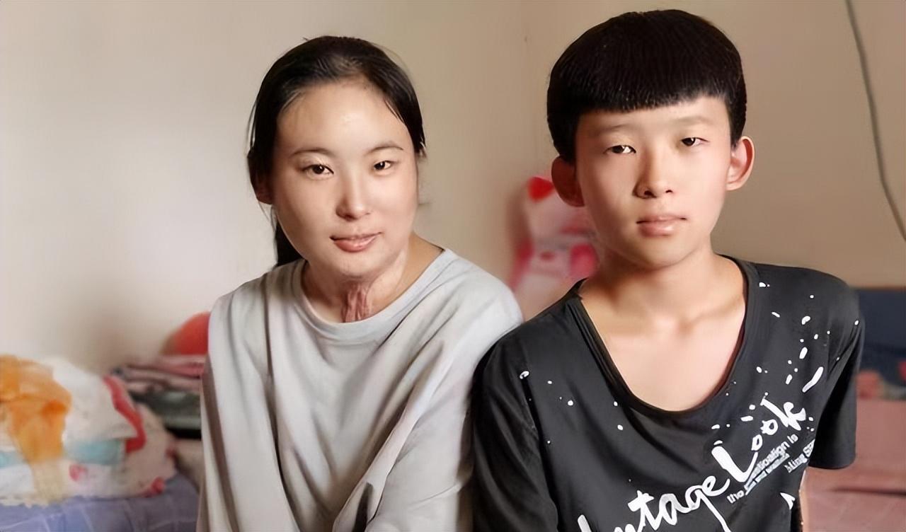 18年河南大火16岁姐姐全身90烧伤毁容弟弟的举动让人泪目