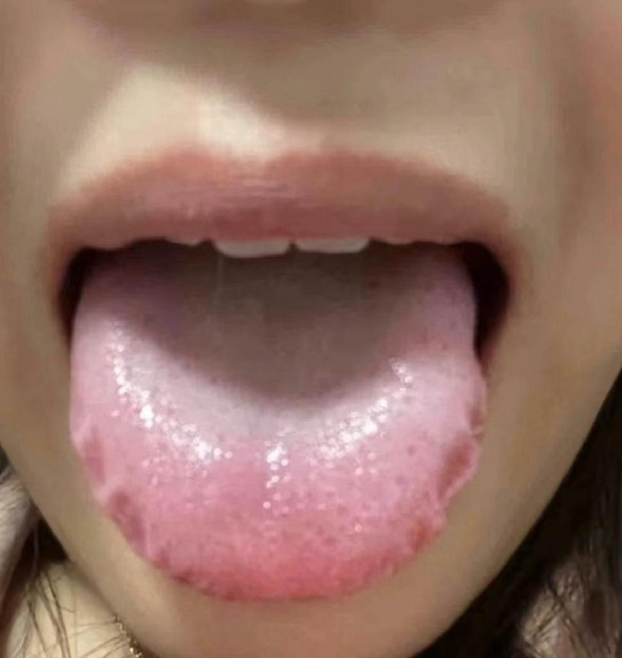 这个样子的齿痕舌,你再去祛湿已经为时已晚,参苓白术芄都没用了