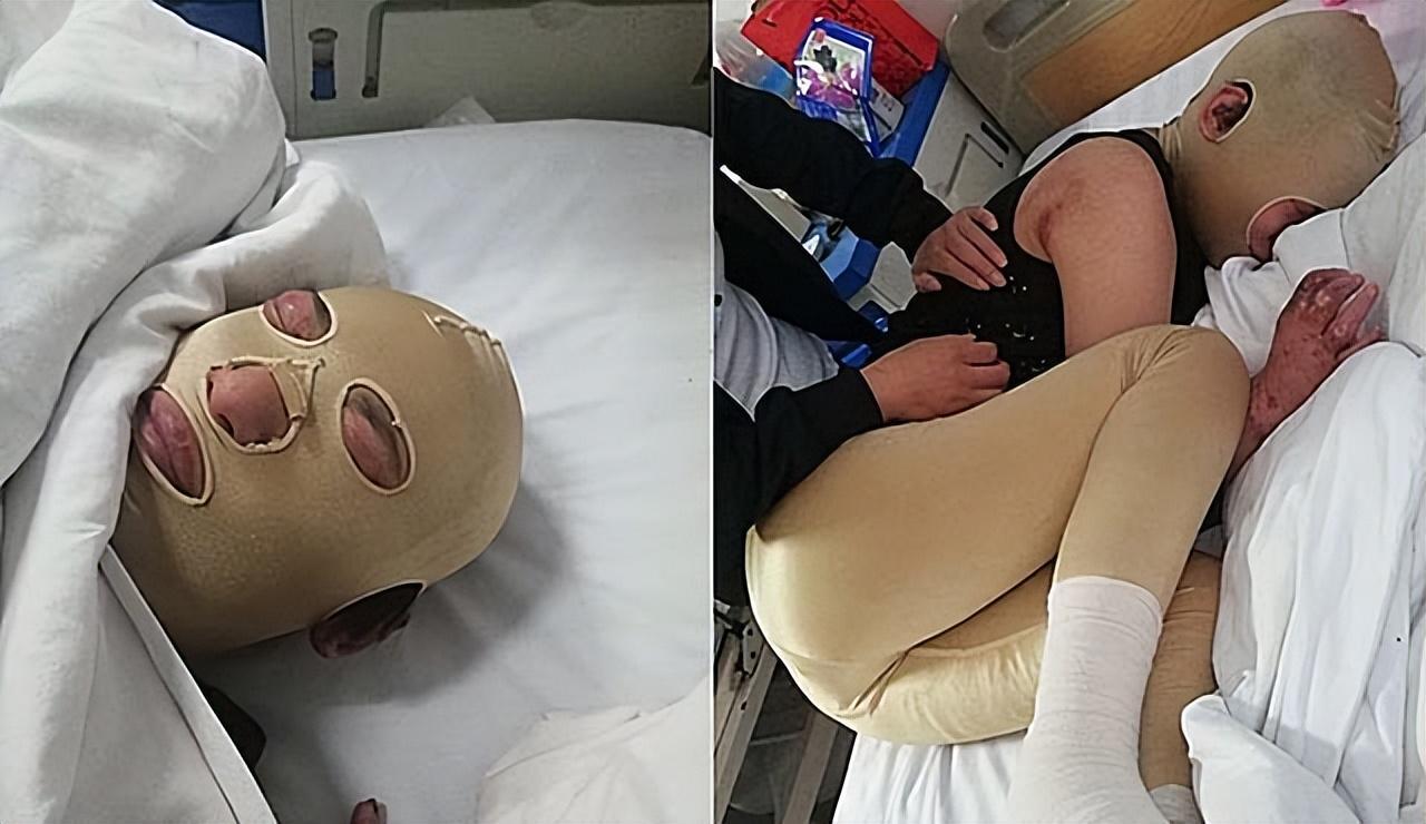 18年河南大火16岁姐姐全身90烧伤毁容弟弟的举动让人泪目