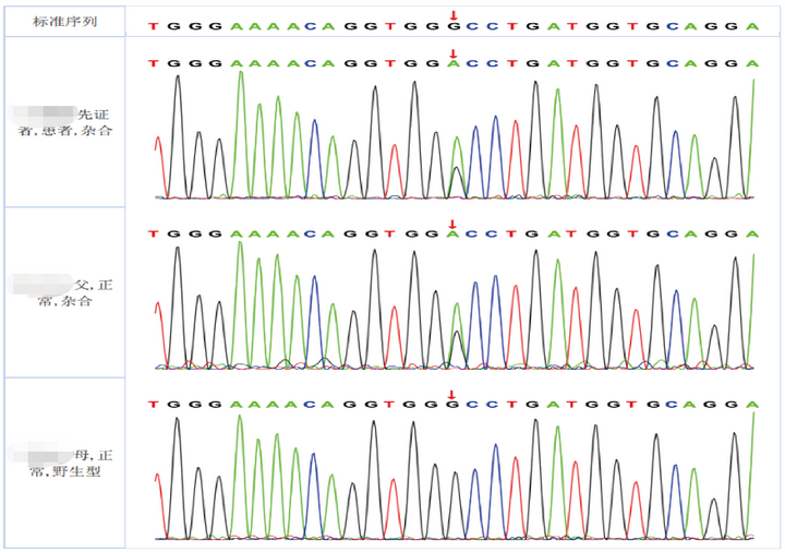 案例2:吡哆醇依赖性癫痫,基因检测仅发现单杂合时怎么办?